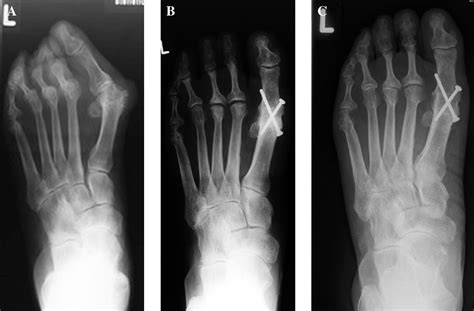 Figure 3 From Preservation Of Lesser Metatarsophalangeal Joints In