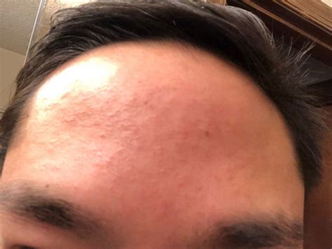 Forehead Bumps Will Not Go Away Affecting Confidence For Work Over The Counter Acne