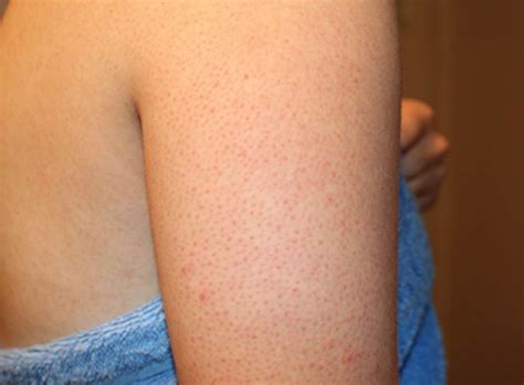 Ever Wonder Why You Get Those Weird Little Red Bumps On Your Arms