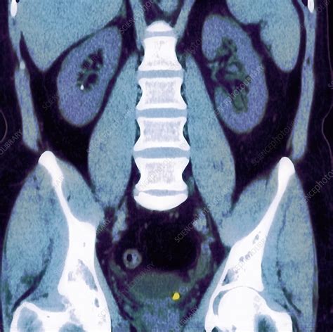 Mri Images Of Kidney Stones Some Kidney Stones May Be Shattered Into