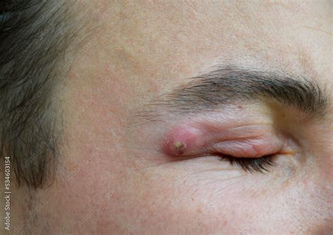 Boil A Strong Purulent Abscess In A Man Near The Eye Swelling From
