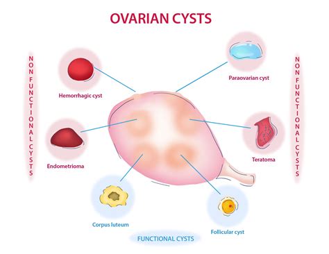 what are cysts anyway — mother nurture wellness