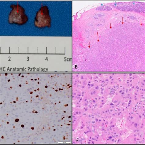 Tuberous Sclerosis Complex And Lymphangioleiomyomatosis Lam In An