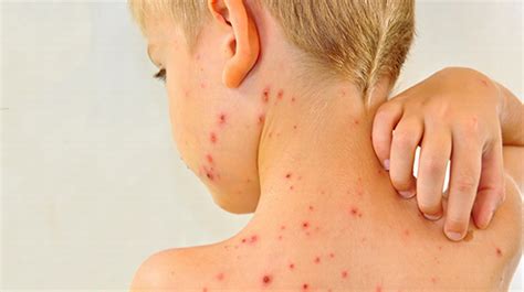 Measles Rubeola Learn The Symptoms And Prevention