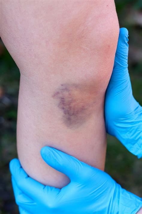 Knee Swelling After A Motorcycle Accident Personal Injury Attorney
