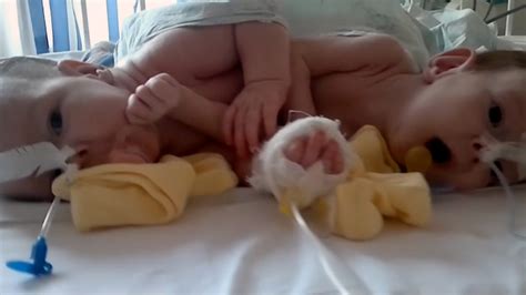 Conjoined Twins Successfully Separated In 10 Hour Long Operation Fox News