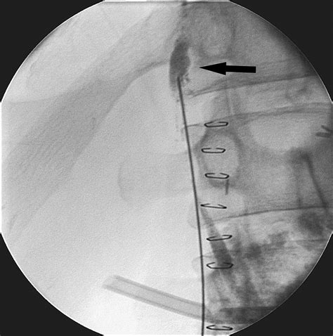 Nonoperative Thoracic Duct Embolization For Traumatic Thoracic Duct