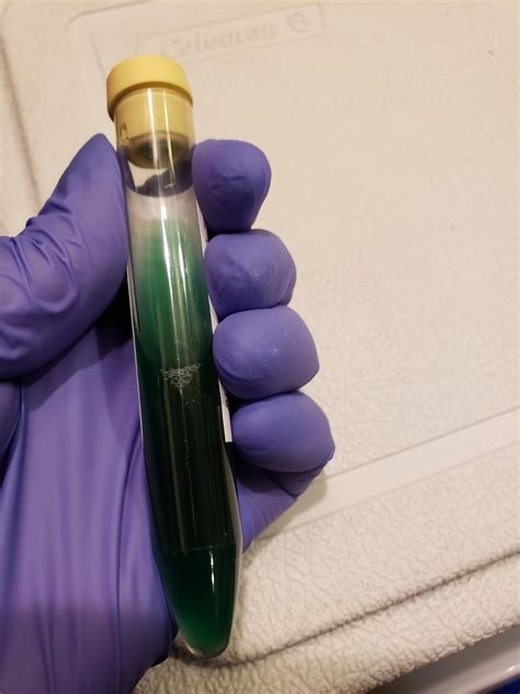 An interesting colored urine we got today! As far as I know it's from