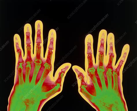 Being a disease that primarily attacks synovial tissues, ra affects synovial joints, tendons, and bursae. Coloured X-ray of hands with rheumatoid arthritis - Stock ...