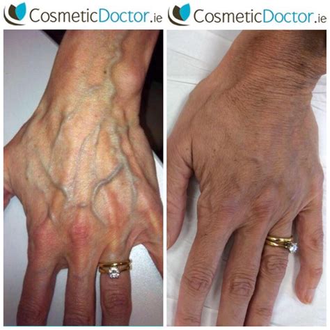 Wrinkly Hands Re Plump And Replenish Volume To Your Hands Cosmetic