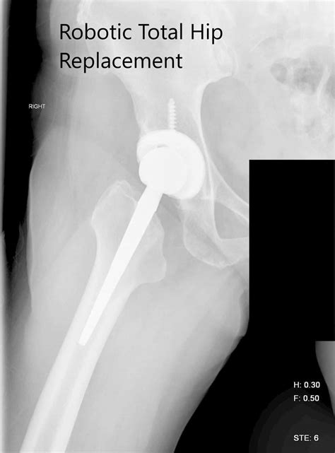 Case Study Management Of Right Hip Arthritis With Robotic Total Hip