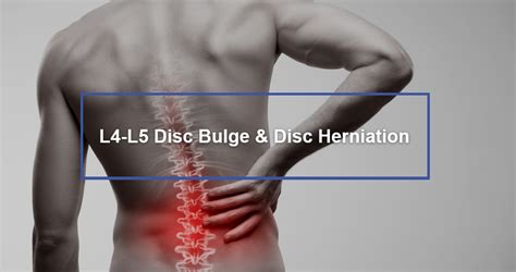 l4 l5 disc bulge and disc herniation dr kevin pauza