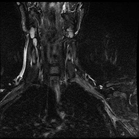Thoracic Outlet Syndrome Treated With Cervical Rib Resection Image