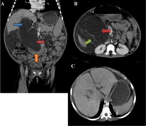 A Coronal Ct Of The Abdomen Shows Cystic Dilatation Of The