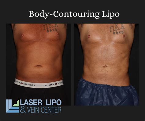 Tumescent Liposuction FAQ S St Louis Laser Liposuction Center