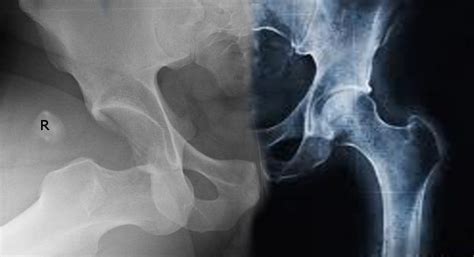 Anterior Hip Dislocation Article