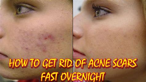 How To Get Rid Of Acne Scars Fast Overnight An Easy Way To Get Rid Of