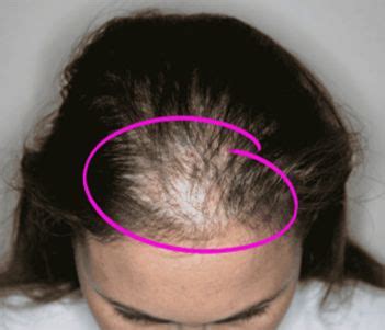 Creciones Artesana Blogspot Causes Of Womens Hair Loss