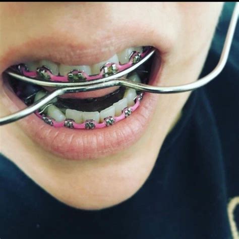 Pin von CD auf Braces Zahnspange Zähne