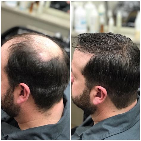Hairskeen Mens Hair Loss Transformation Hair Loss Men Reduce Hair