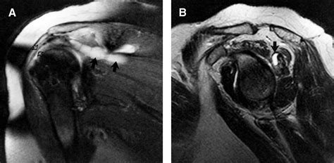 Association Of Intramuscular Cysts Of The Rotator Cuff With Tears Of