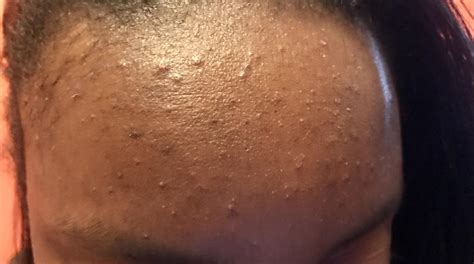 Skin Concern Bumps On Forehead What Could It Be Rskincareaddiction