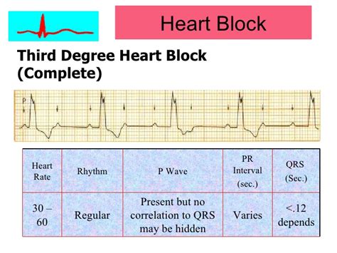 The p waves are from the sinus node, and patients with chb that results in a very slow heart rate sometimes need emergency treatment aimed at increasing the rate. Cardiac arrhythmias