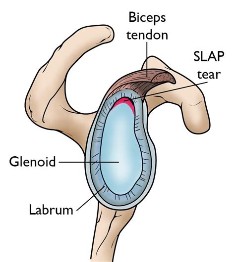 SLAP Tears OrthoInfo AAOS