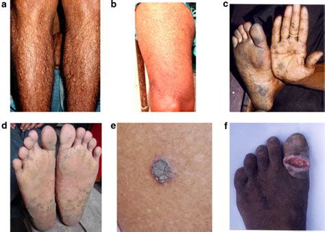 Different Types Of Arsenic Induced Skin Lesions A Classical Raindrop