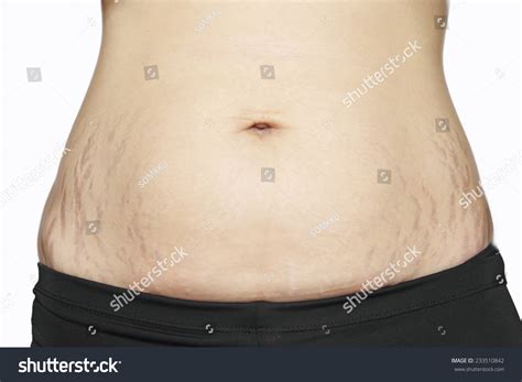 Pregnant Stretch Marks Belly Images Stock Photos Vectors