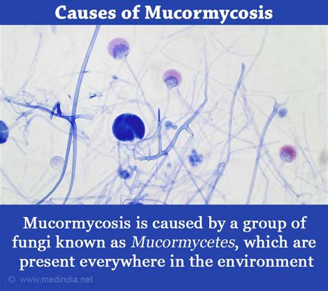 Mucormycosis Black Fungal Disease Print