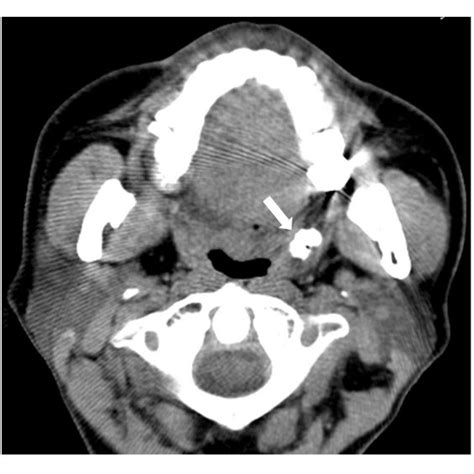 Axial Ct Images A Single Large Tonsillolith In The Left Palatine