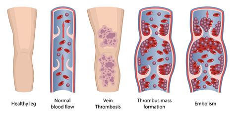 Deep Vein Thrombosis Blood Clots Treatments In Phoenix AZ
