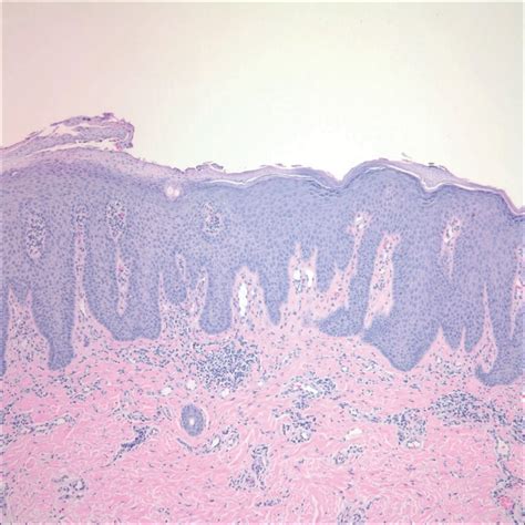 Inflammatory Linear Verrucous Epidermal Nevus Responsive To 308 Nm