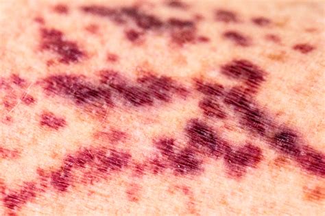 Purpura Vaskulitis Oder Gebrochene Blutgefäße Auf Der Menschlichen Haut
