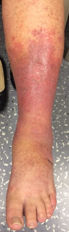 Is It Cellulitis The Case Of Itchy Red Legs Aimed Lets Talk About