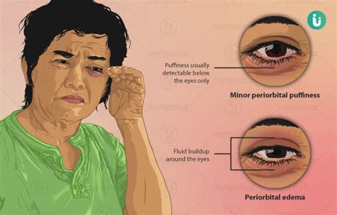 Eye Drops For Swollen Eyes Online Save 40 Jlcatjgobmx