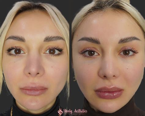 Russian Lip Filler Before After Results Skinly Aesthetics