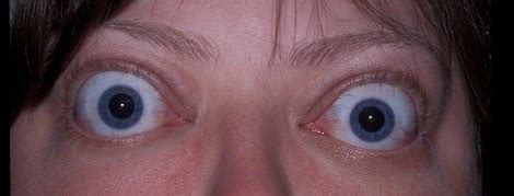 Several authors use the terms differently, which can be confusing: Bulging Eyes (Proptosis) — Symptoms & Treatment
