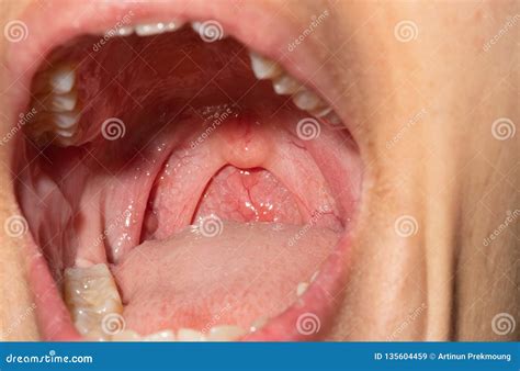 Sore Throat With Throat Swollen Closeup Open Mouth With Posterior