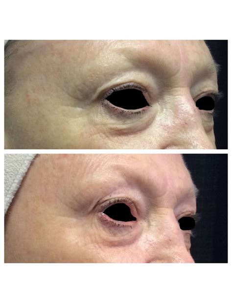 Ultherapy Periorbital Before And After 6 Months Denverlaser