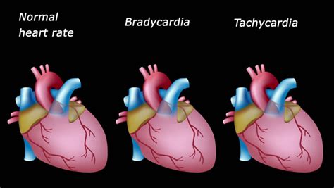 Heart rate can be increased because of either an increased activity of sympathetic nerve fibers or a decreased activity of parasympathetic nerve fibers and vice versa for a decrease in heart rate. Abnormal Rapid Human Heart Beat Tachycardia Arrhythmia In ...