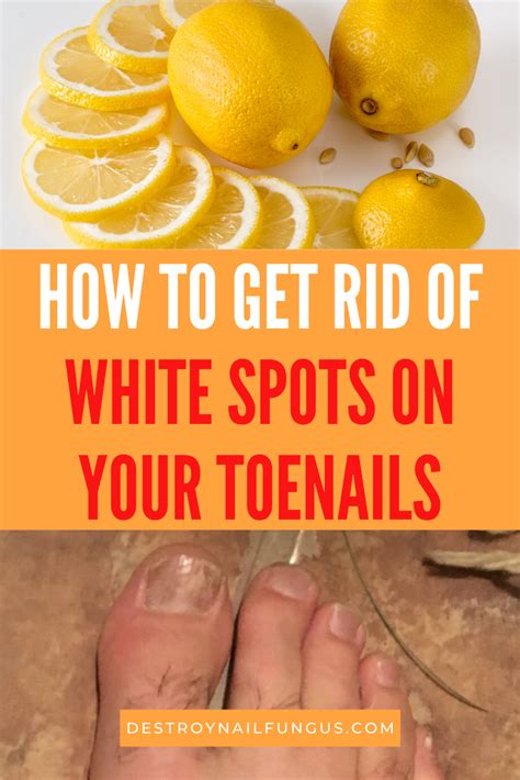 7 Effective Home Remedies For White Spots On Toenails