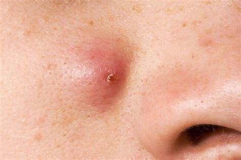 Skin Problems A Visual Guide To Cysts