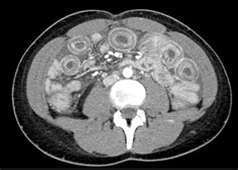 Computed Tomography Scan Of The Abdomen And Pelvis With Contrast
