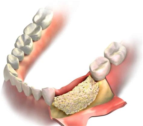 Bone Grafting For Dental Implant 6 Types Of Bone Graft