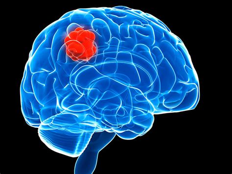 Promising New Treatment For Deadliest Form Of Brain Cancer University