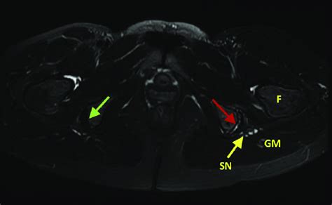 Axial Magnetic Resonance Image Of Hip T2 Sequence One Should Observe