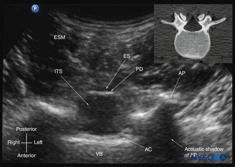 Ultrasound Spine Anatomy