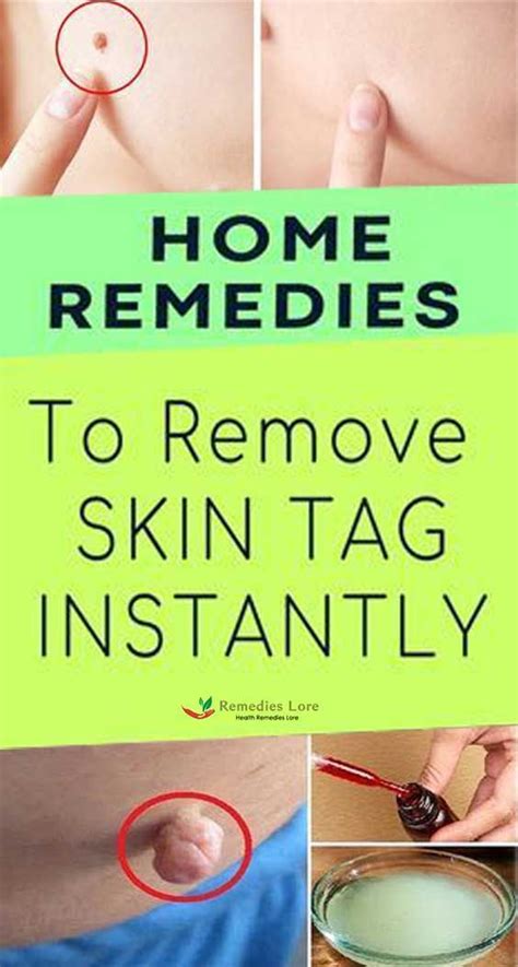 top 10 home remedies to remove skin tags naturally skin tag removal skin tags home remedies